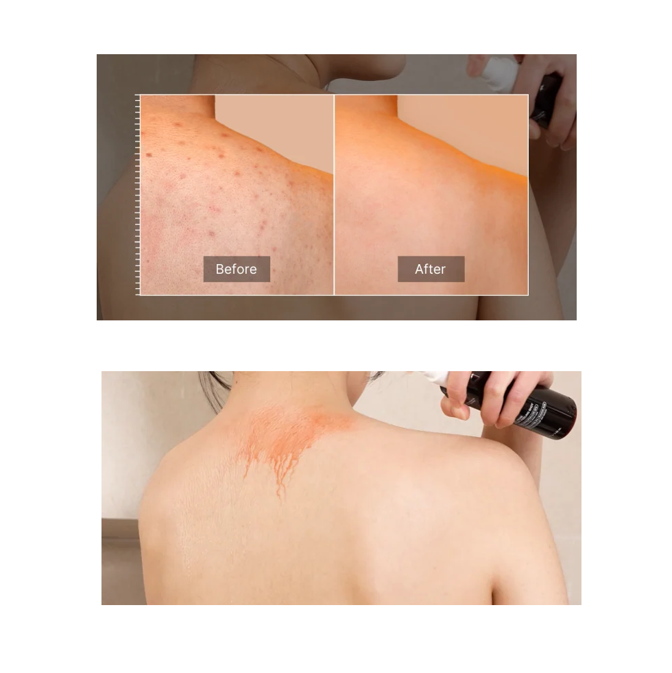 Medicube-Red Acne Body Peeling Shot 110g